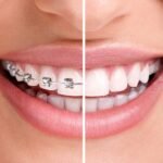 invisalign-braces-teenedit-dentcare