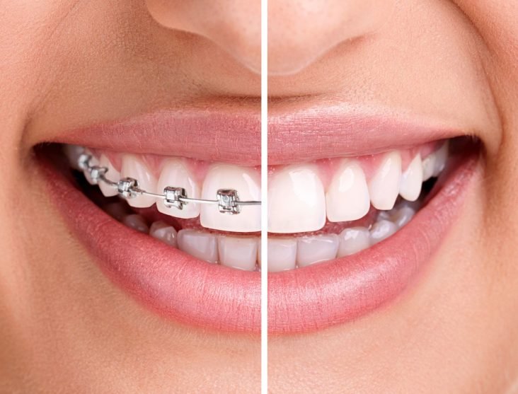 invisalign-braces-teenedit-dentcare